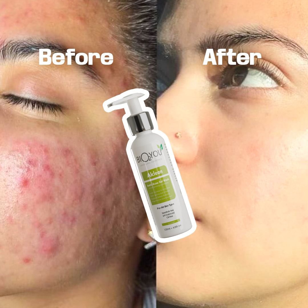 Aklean Anti-Acne Face Wash