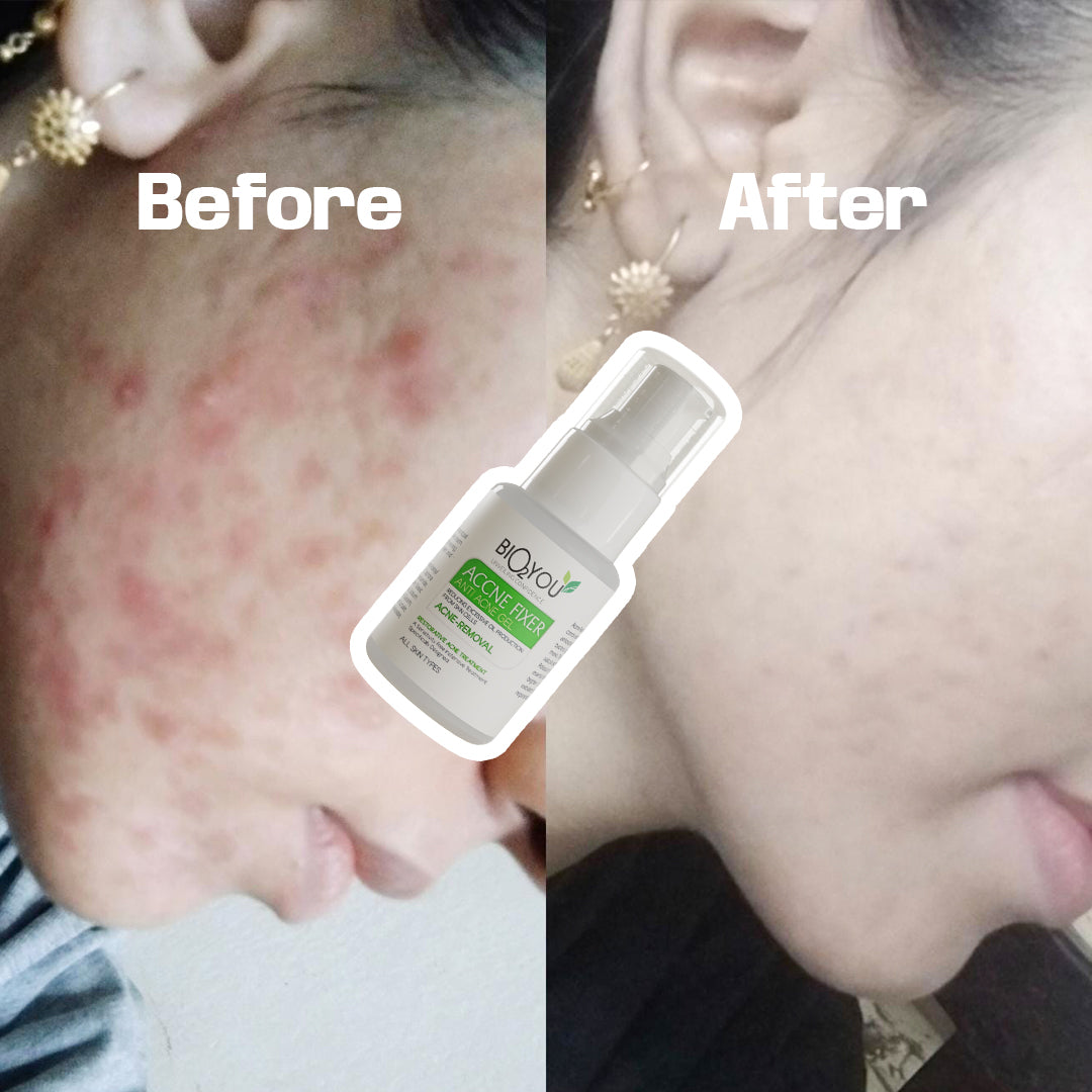 Anti Acne Gel